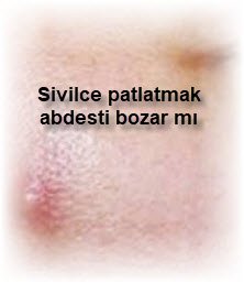 Sivilce patlatmak abdesti bozar mı 2 Sivilce patlatmak abdesti bozar mi