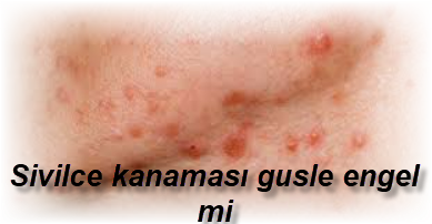Sivilce kanamasi gusle engel mi
