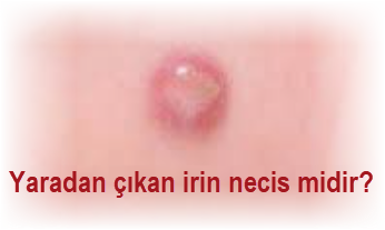 Yaradan cikan irin necis midir